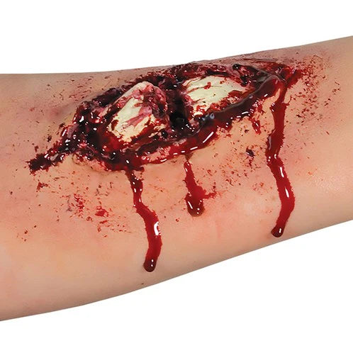 Broken Bone Wound Appliance